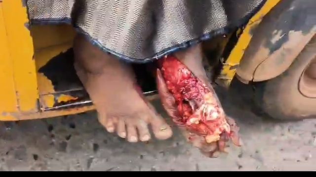 నెల్లూరు జిల్లా…గూడూరు.**💥గూడూరు పాత బస్ స్టాండ్ లో బస్సు ప్రమాదం…*💥బస్సు ఎక్కుతుండగా జారి పడిన మహిళా ప్రయాణికురాలు కాలు పై నుండి వెళ్ళిన బస్సు
